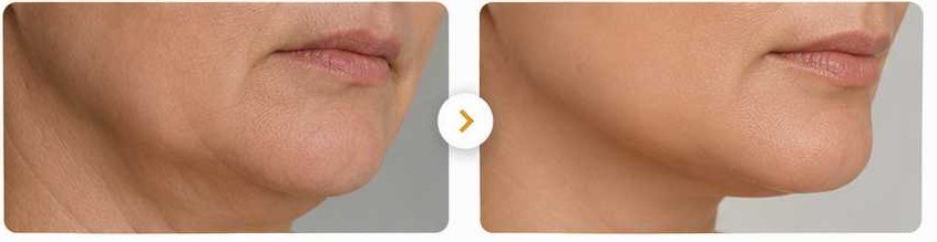 Antes e depois — flacidez